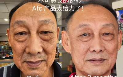 A 70-year-old uncle has reversed aging and rejuvenated.