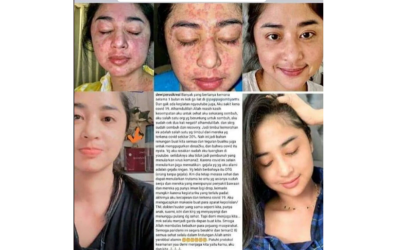 LONG COVID caused facial redness, which improved with the help of AFC.