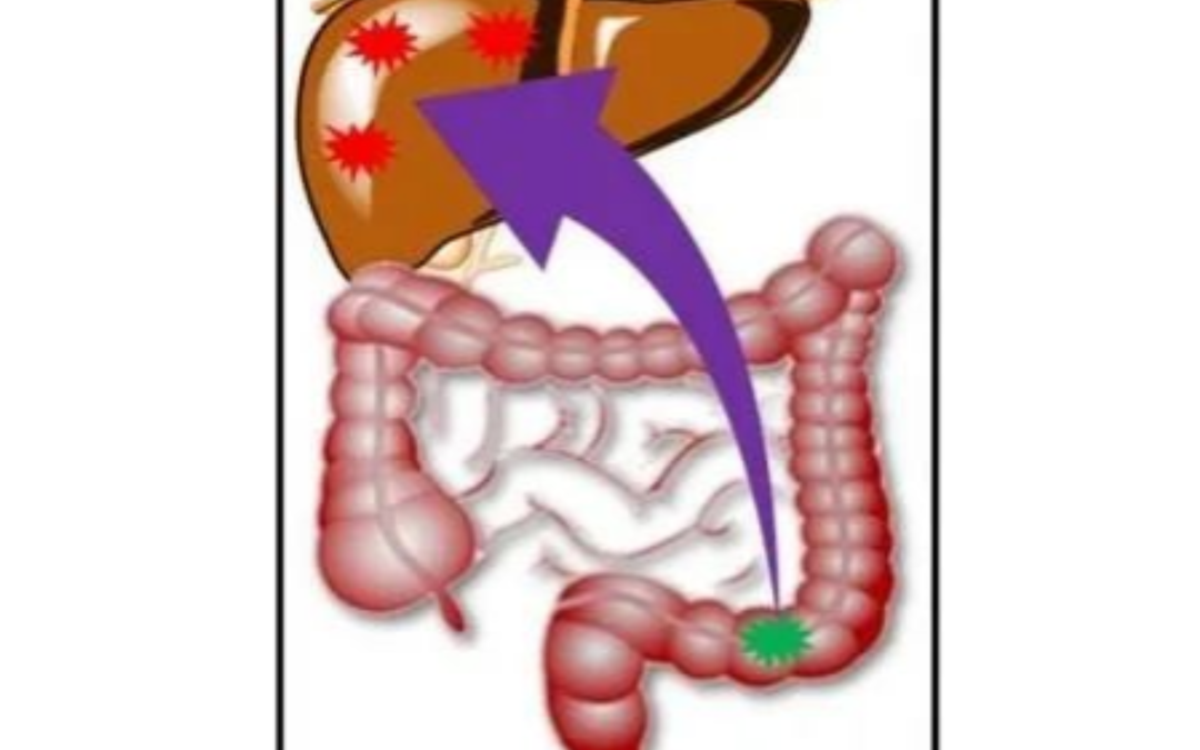 Stage 4 colorectal cancer recovered after taking AFC superfood.