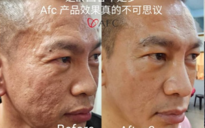 Vascular aging, skin scars healed in 3 weeks.