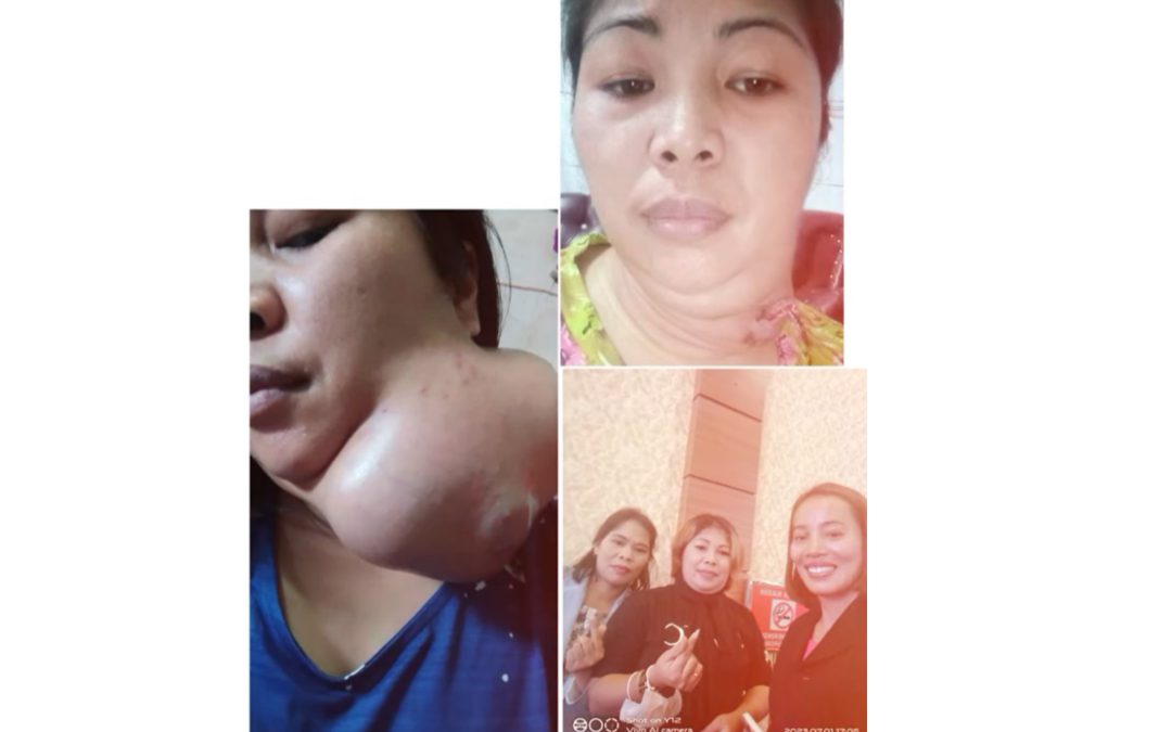 The cancerous tumor miraculously disappeared; it started shrinking significantly just 14 days after taking the treatment.