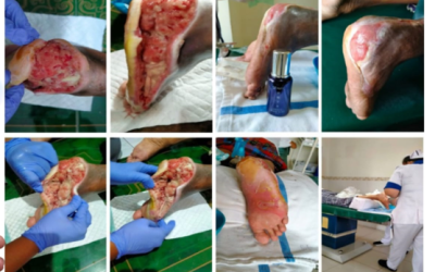 The diabetic foot ulcer miraculously improved and healed, no need for amputation anymore.